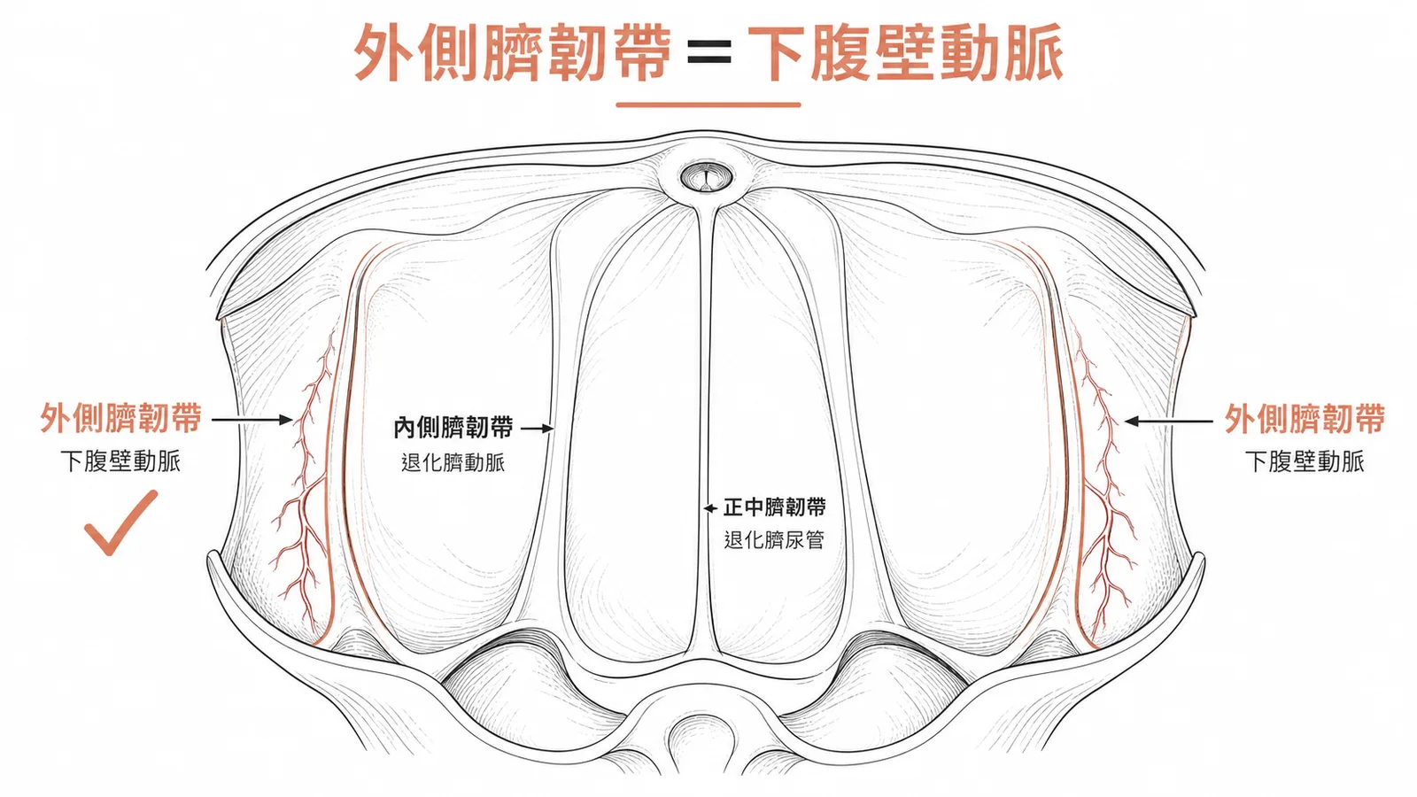 腹前壁三皺褶:正中臍韌帶包臍尿管、內側臍韌帶包退化臍動脈、外側臍韌帶包下腹壁動脈