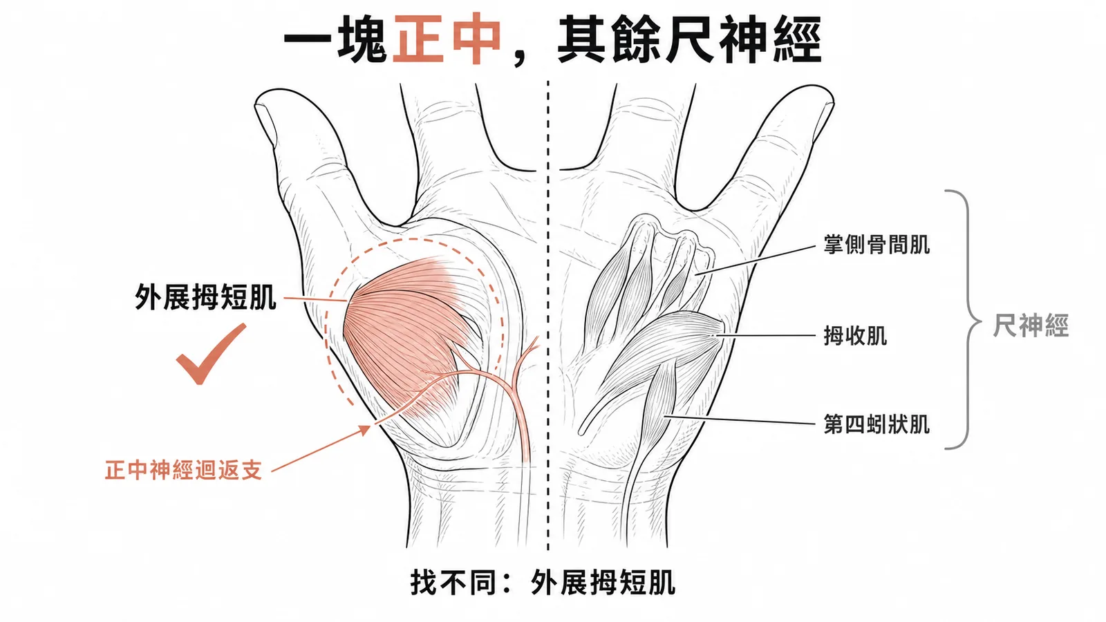 外展拇短肌由正中神經迴返支支配,其餘手內在肌掌側骨間肌內收拇肌第四蚓狀肌由尺神經支配