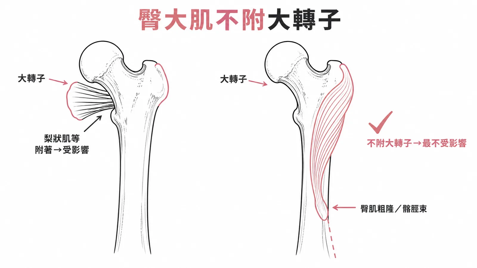 臀大肌主要附著於股骨臀肌粗隆與髂脛束、不附著大轉子,故大轉子骨折時其功能最不受影響;梨狀肌等附著大轉子者會受影響