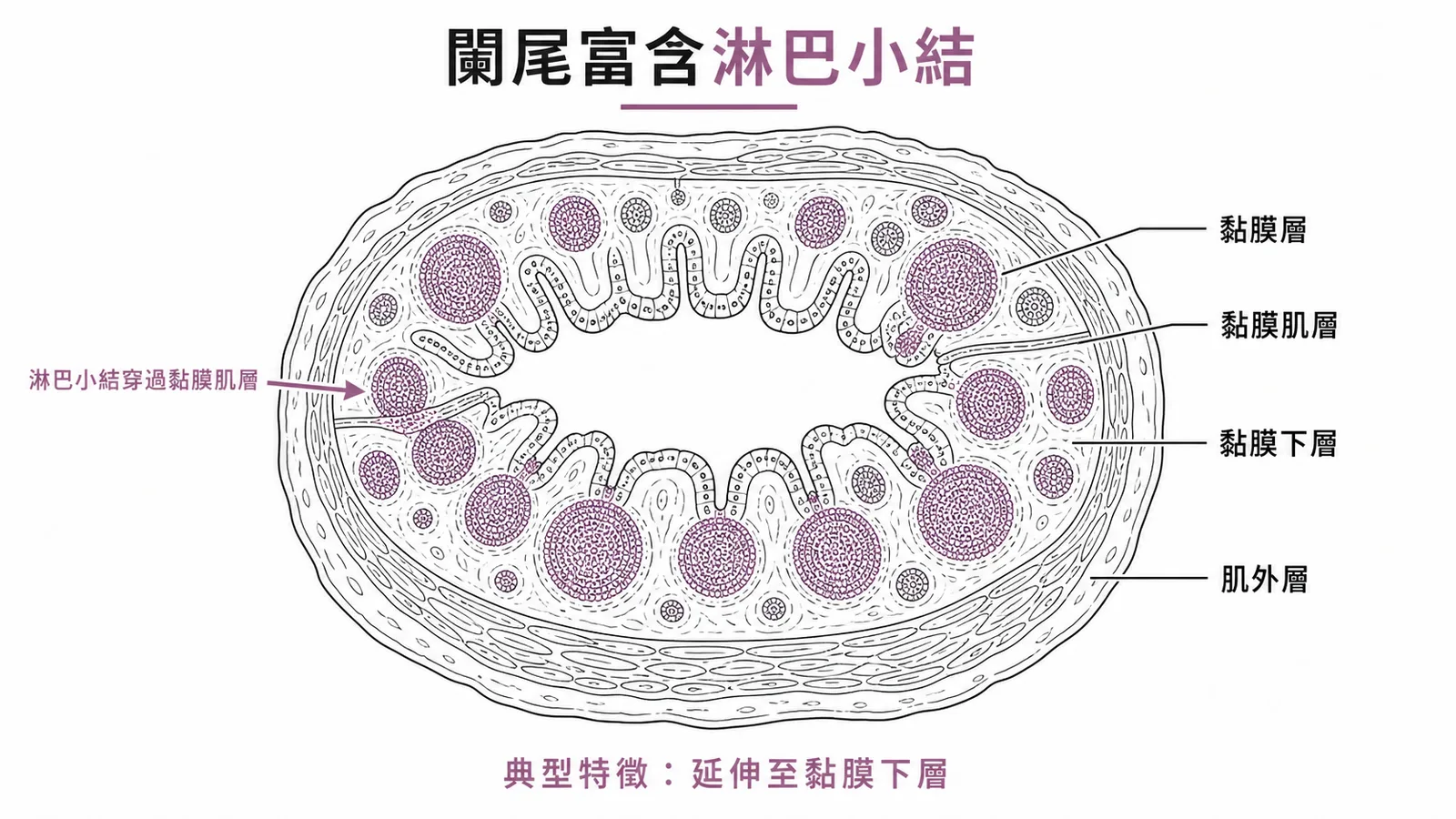 闌尾富含淋巴小結、穿過黏膜肌層延伸至黏膜下層
