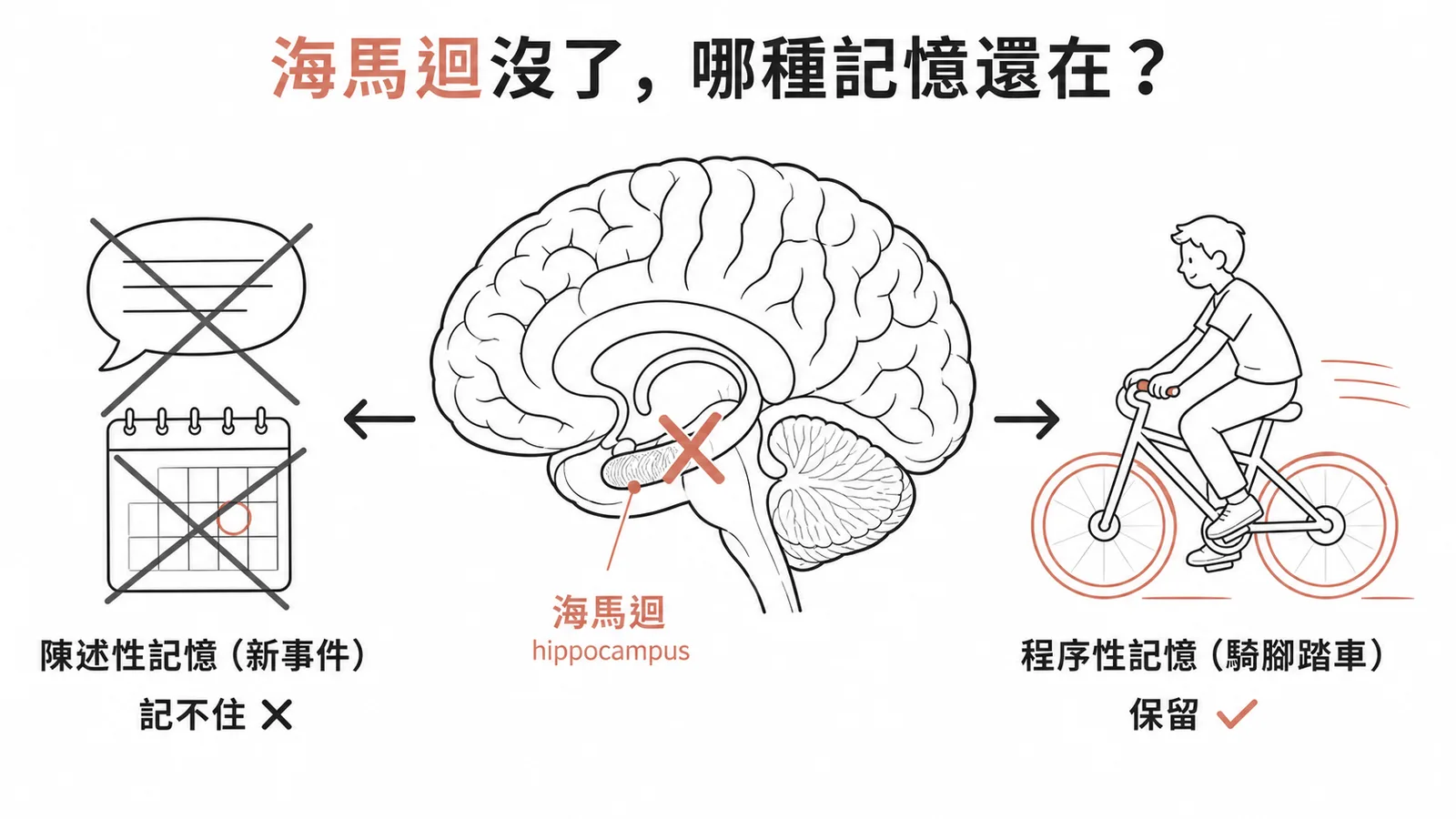 兩側海馬迴切除後新陳述性記憶喪失、程序性記憶(騎腳踏車)保留