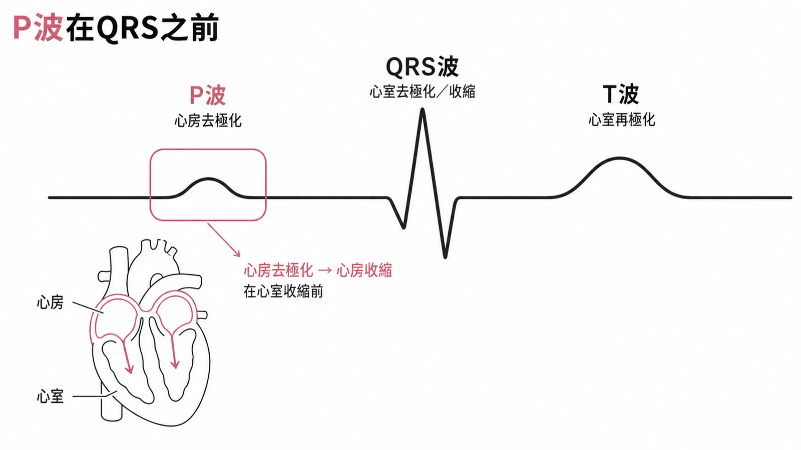 P波代表心房去極化、發生在心室收縮(QRS)之前