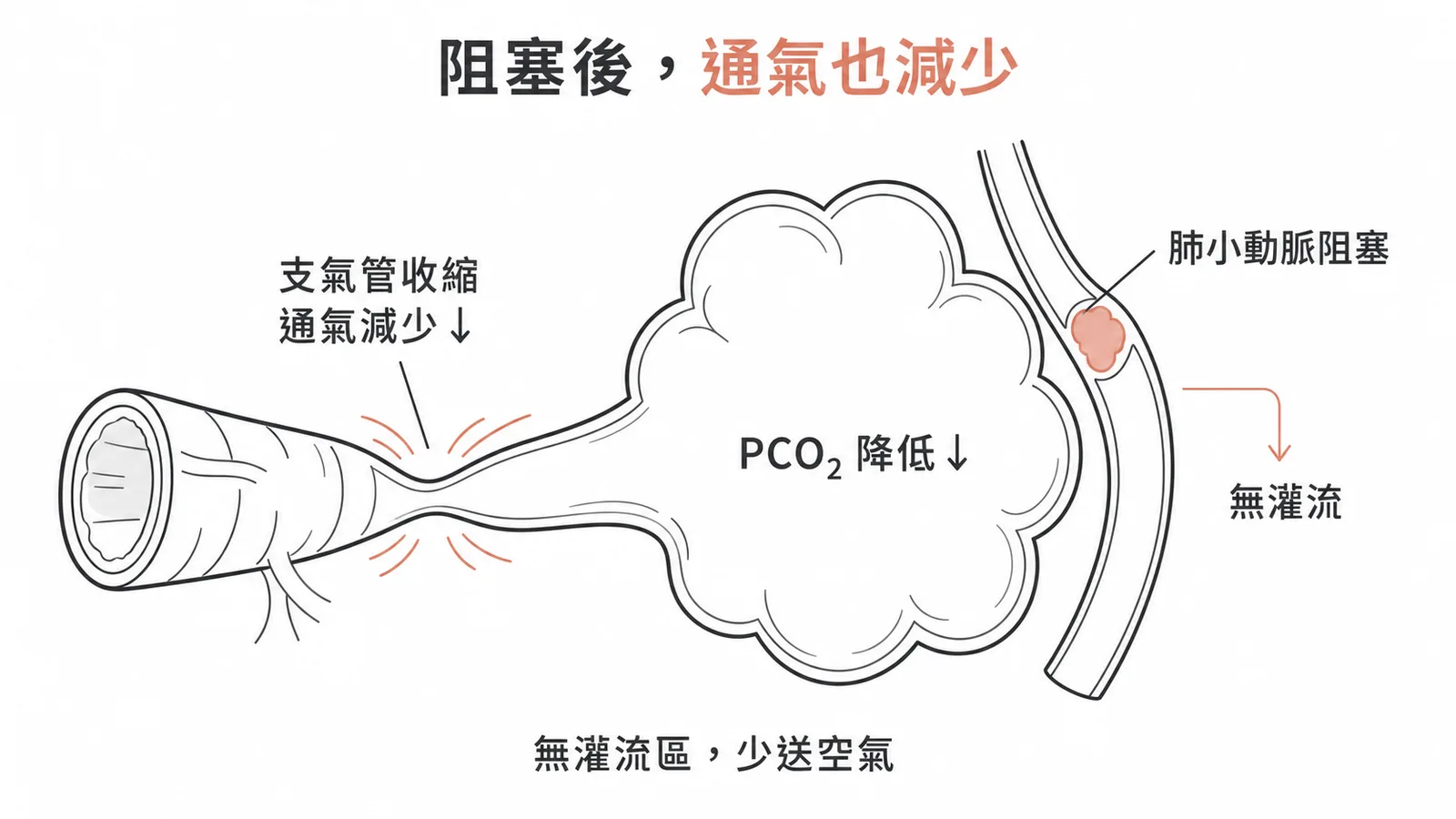 肺小動脈阻塞→該區無灌流→肺泡PCO₂降低→支氣管收縮、通氣減少
