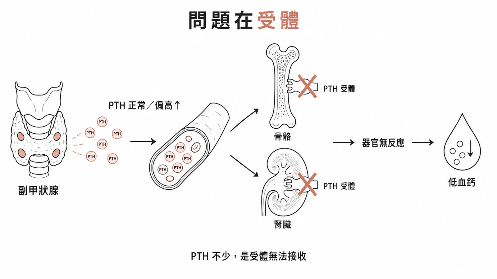假性副甲狀腺功能低下:PTH偏高但目標器官受體缺陷、無反應致低血鈣