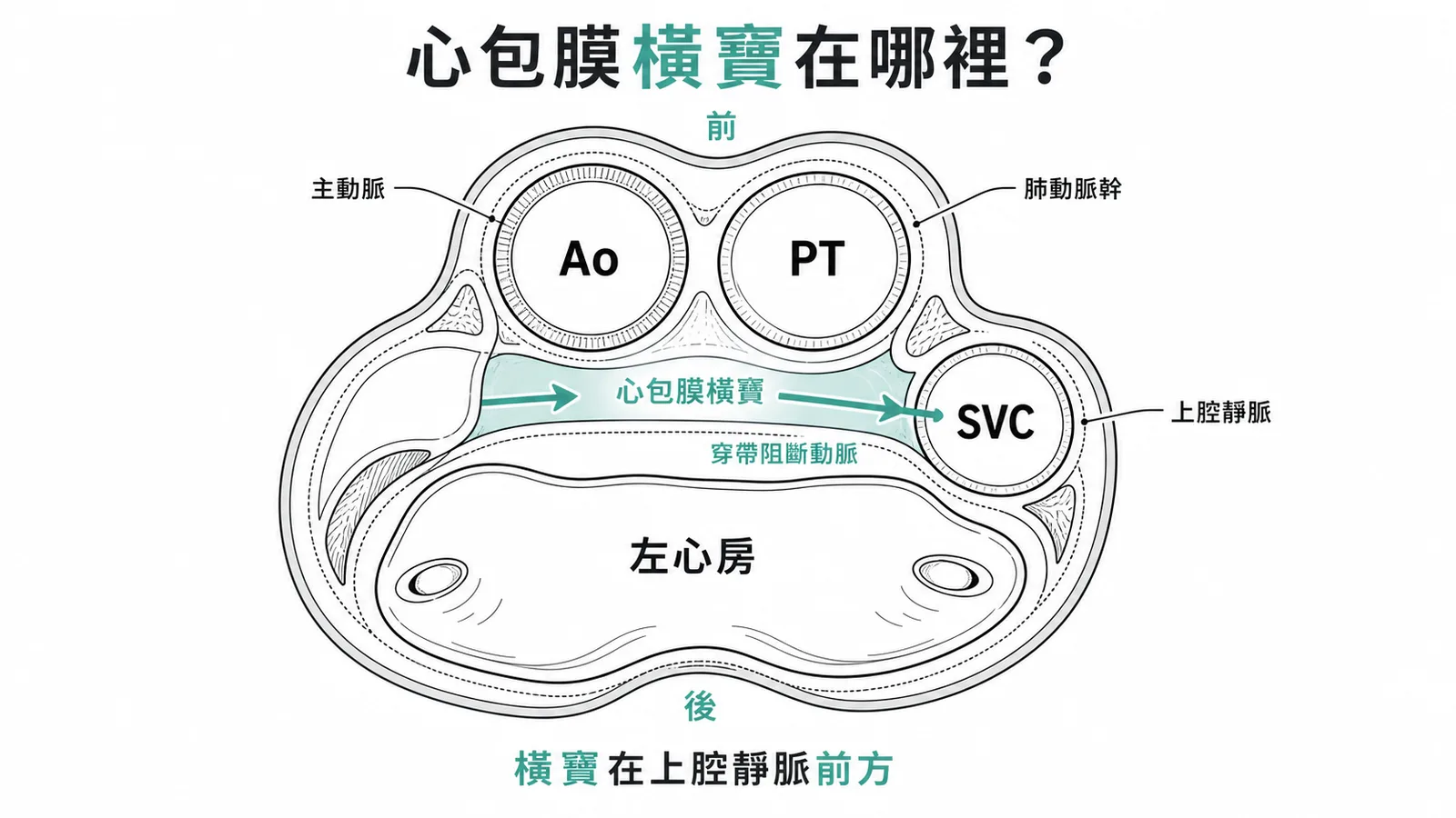 心包膜橫竇位於主動脈和肺動脈幹後方、上腔靜脈前方示意圖