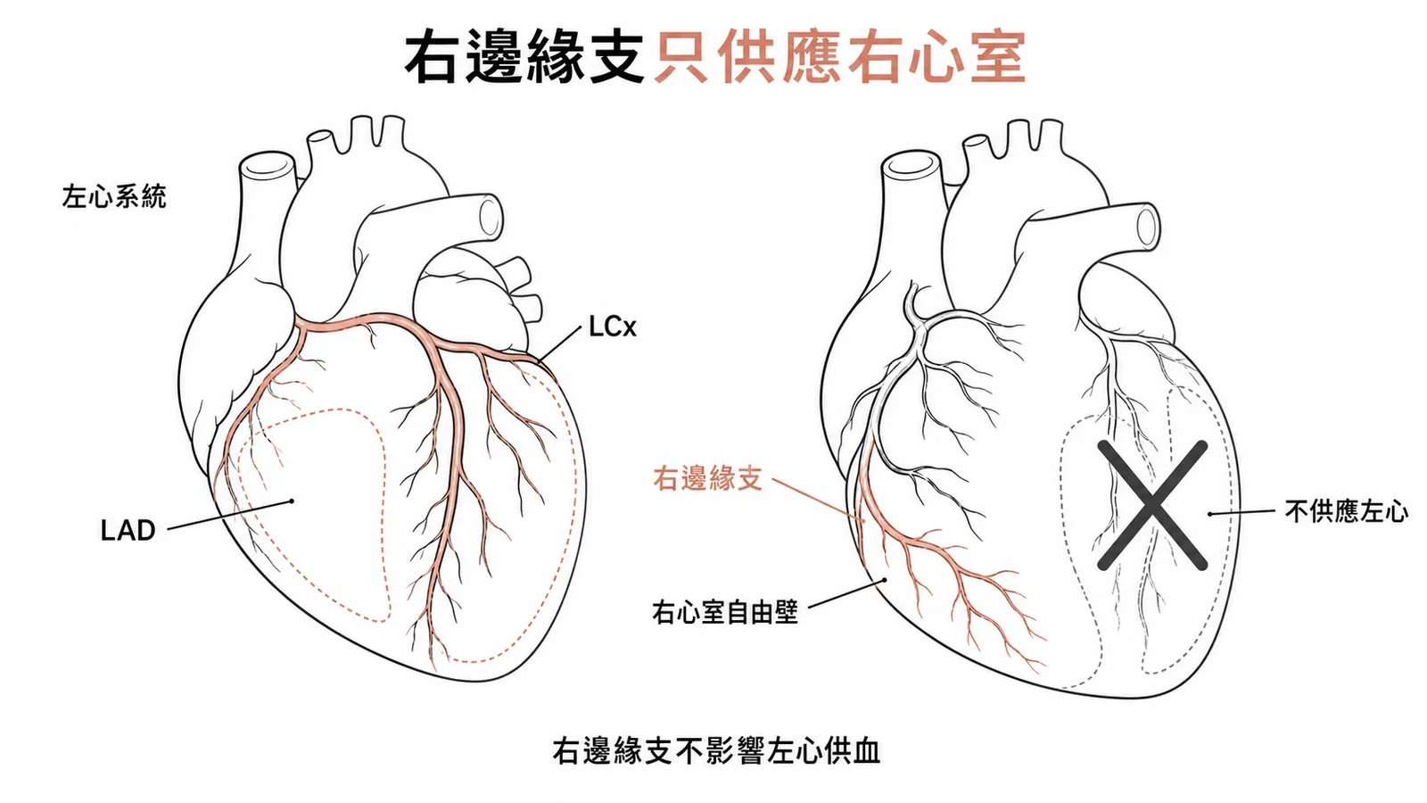 右邊緣支僅供應右心室不影響左心缺氧區域示意圖