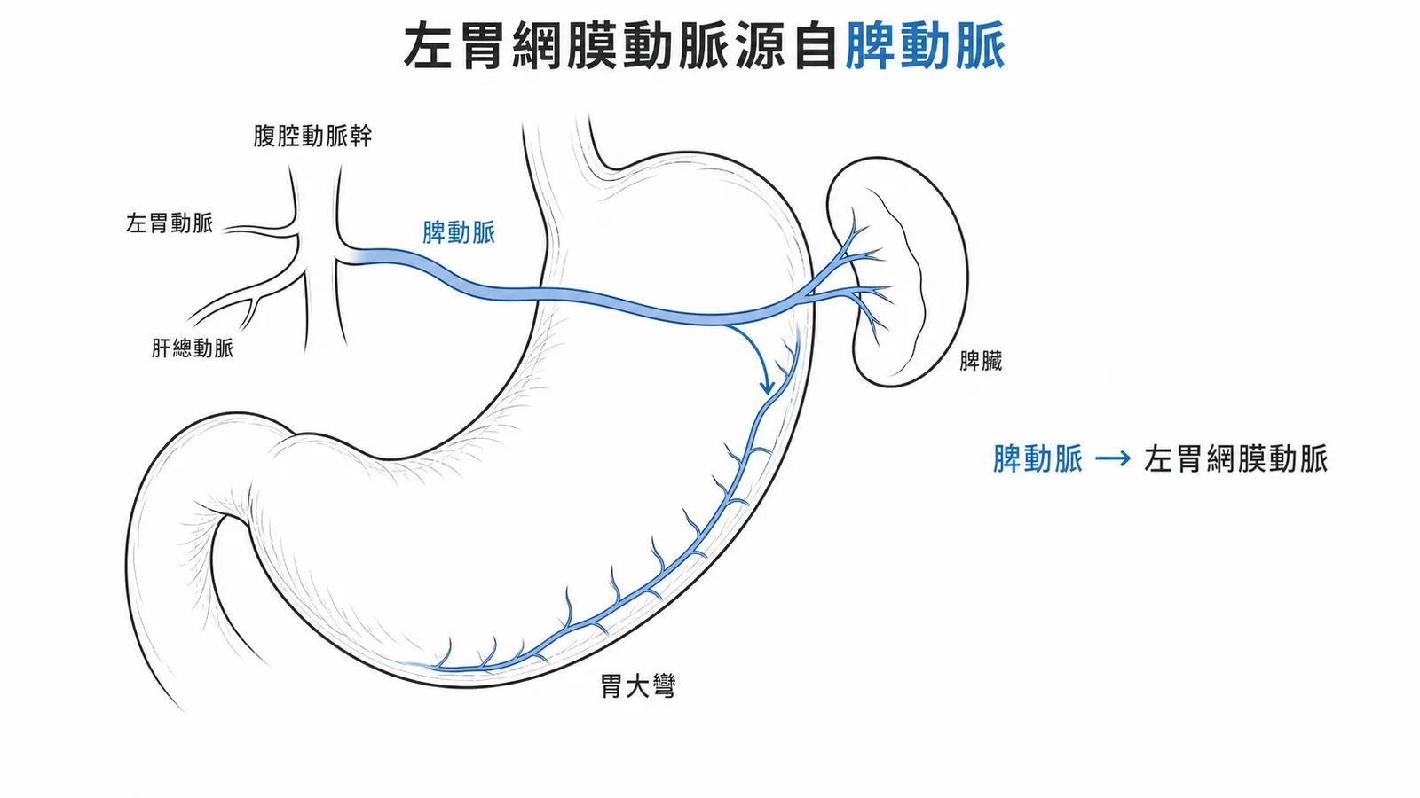 左胃網膜動脈源自脾動脈沿胃大彎走行示意圖