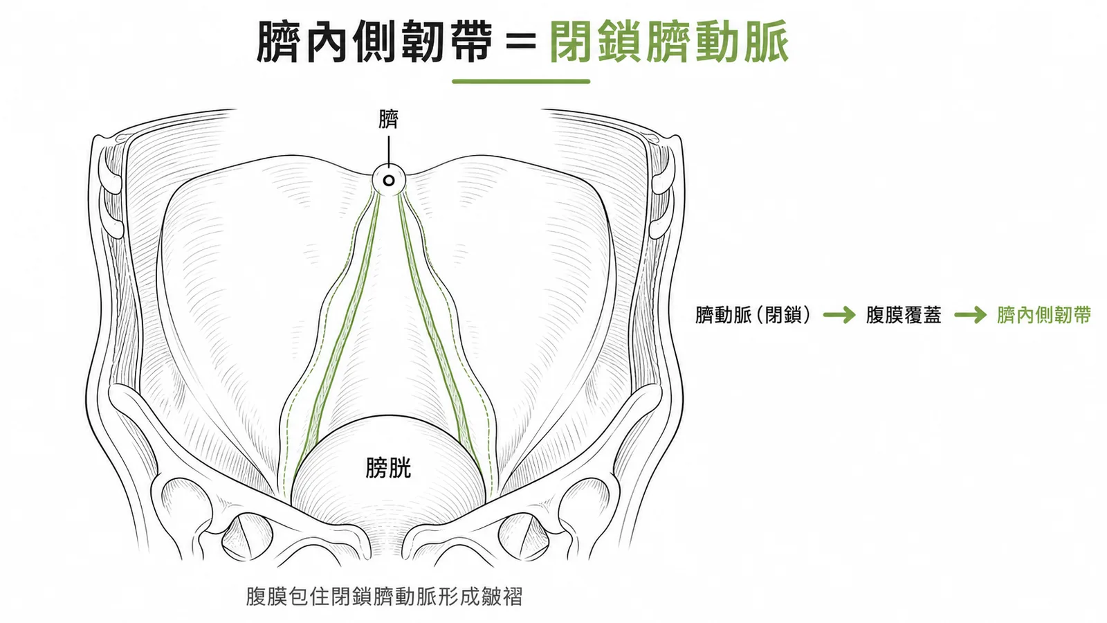 臍內側韌帶由閉鎖的臍動脈被腹膜覆蓋而成