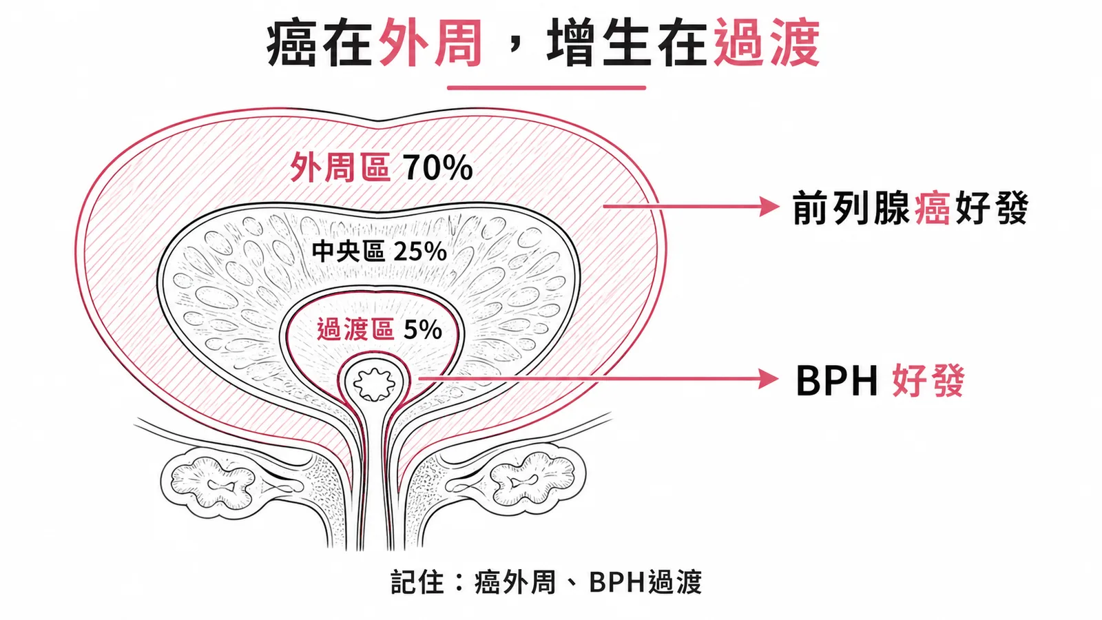前列腺癌好發於外周區而非過渡區