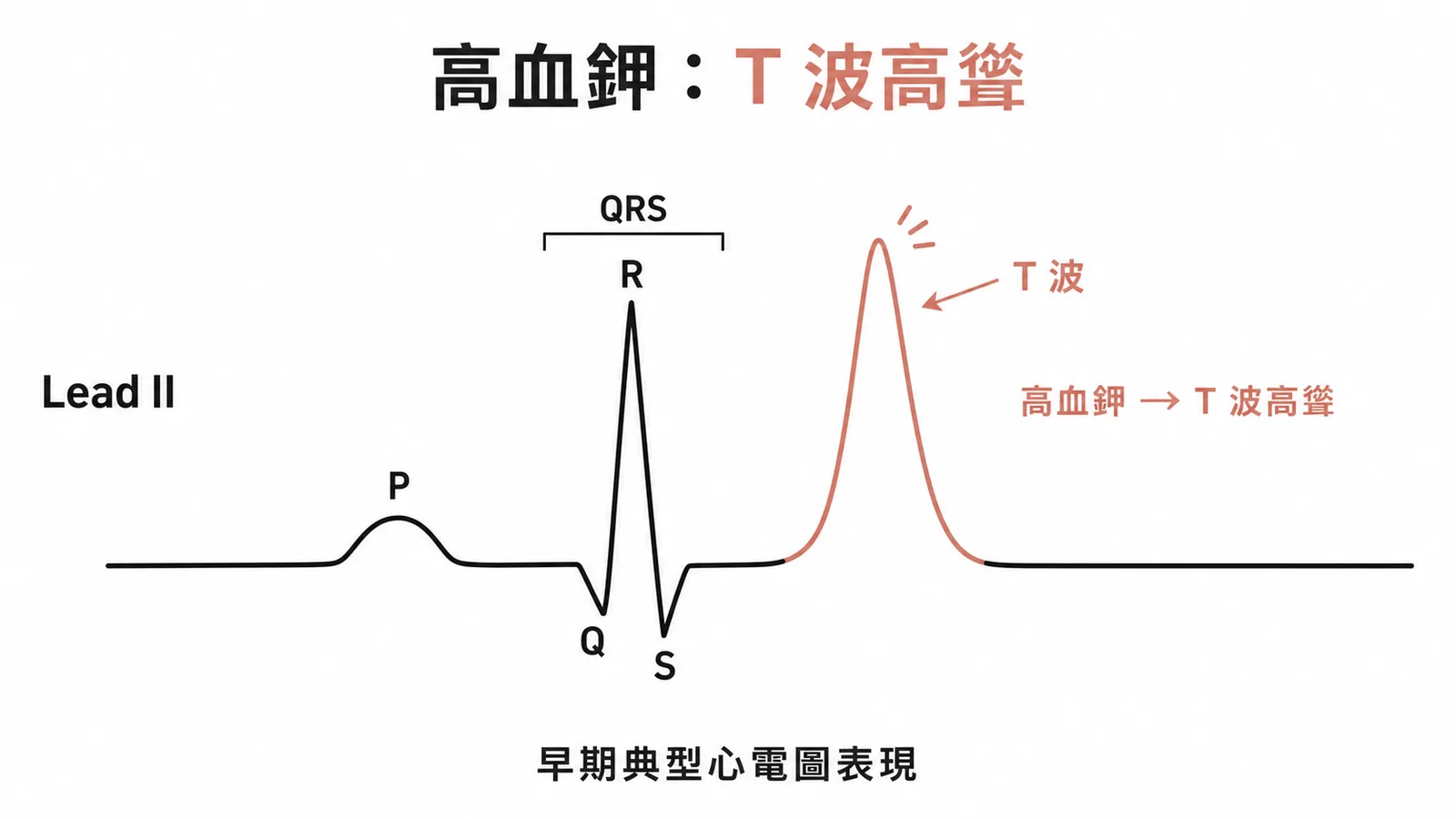 高血鉀時心電圖Lead II出現高聳T波的典型表現