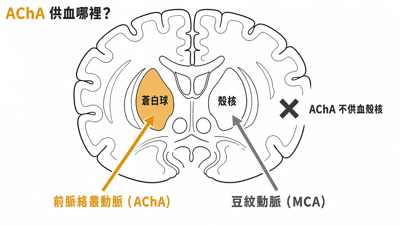 前脈絡叢動脈供血蒼白球而非殼核示意圖