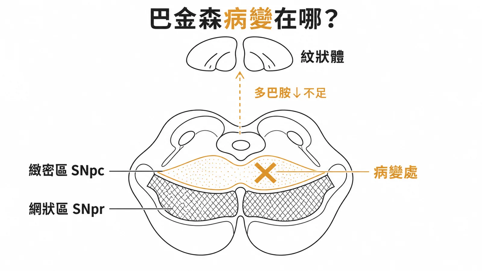 巴金森氏症病變在黑質緻密區SNpc示意圖