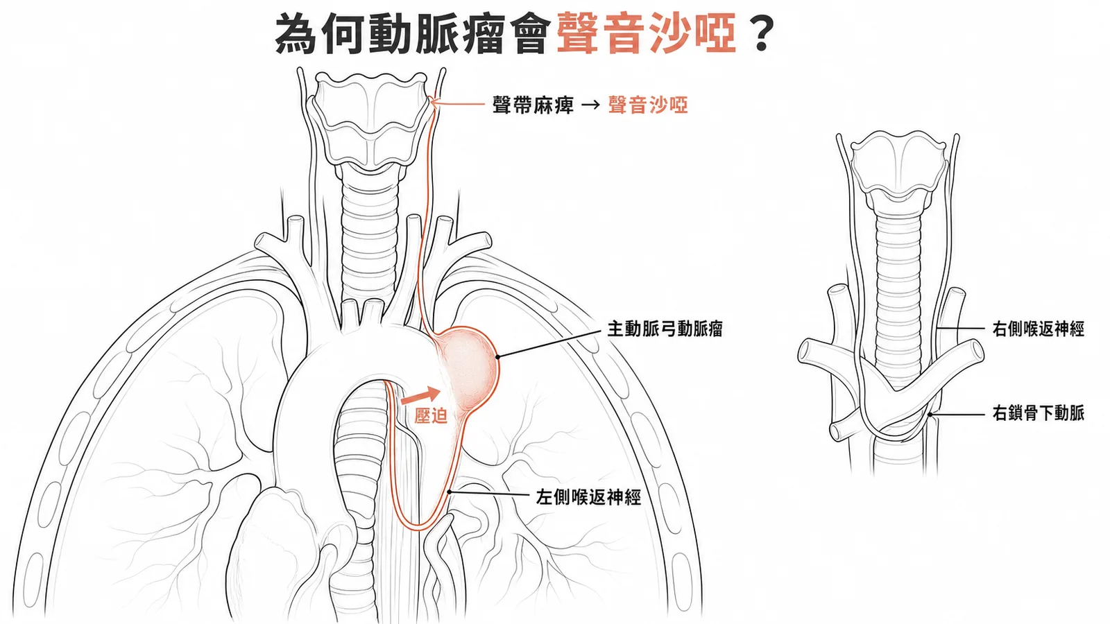 主動脈弓動脈瘤壓迫左側喉返神經導致聲音沙啞