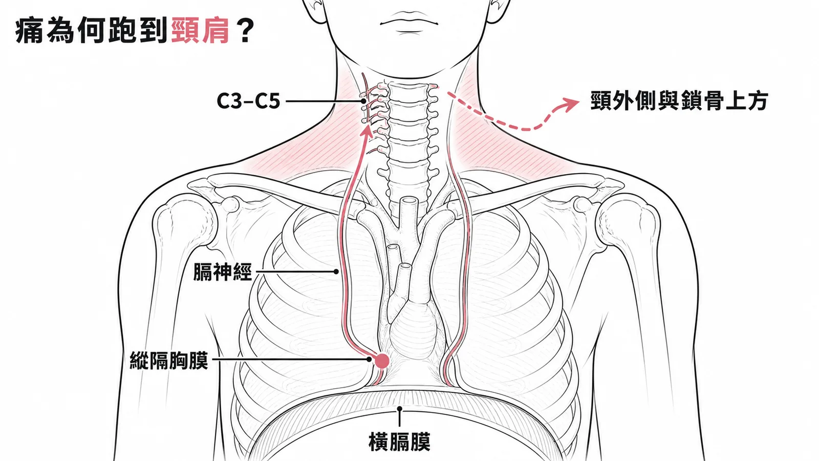 縱隔胸膜痛覺經膈神經C3-C5傳導至頸肩轉位痛