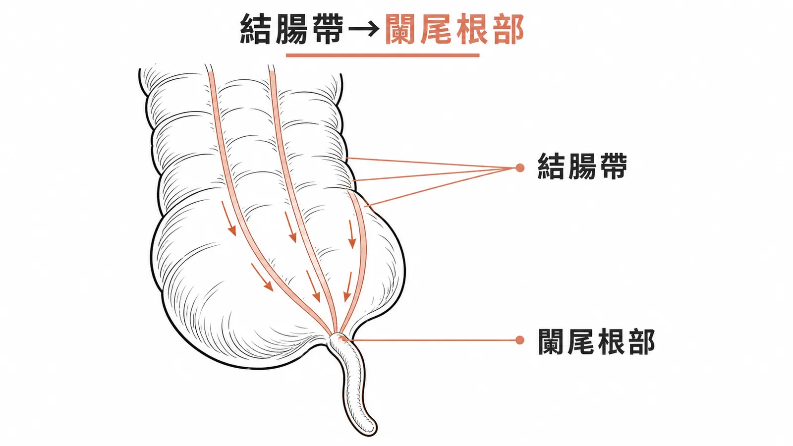 盲腸上三條結腸帶匯聚至闌尾根部示意圖