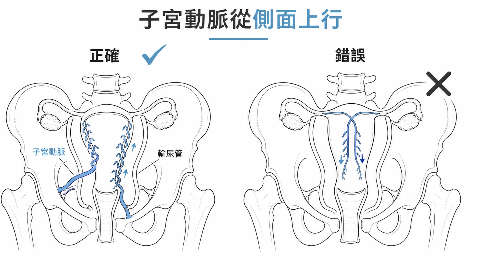 子宮動脈從側面進入沿側緣上行的正確走向與錯誤概念對照