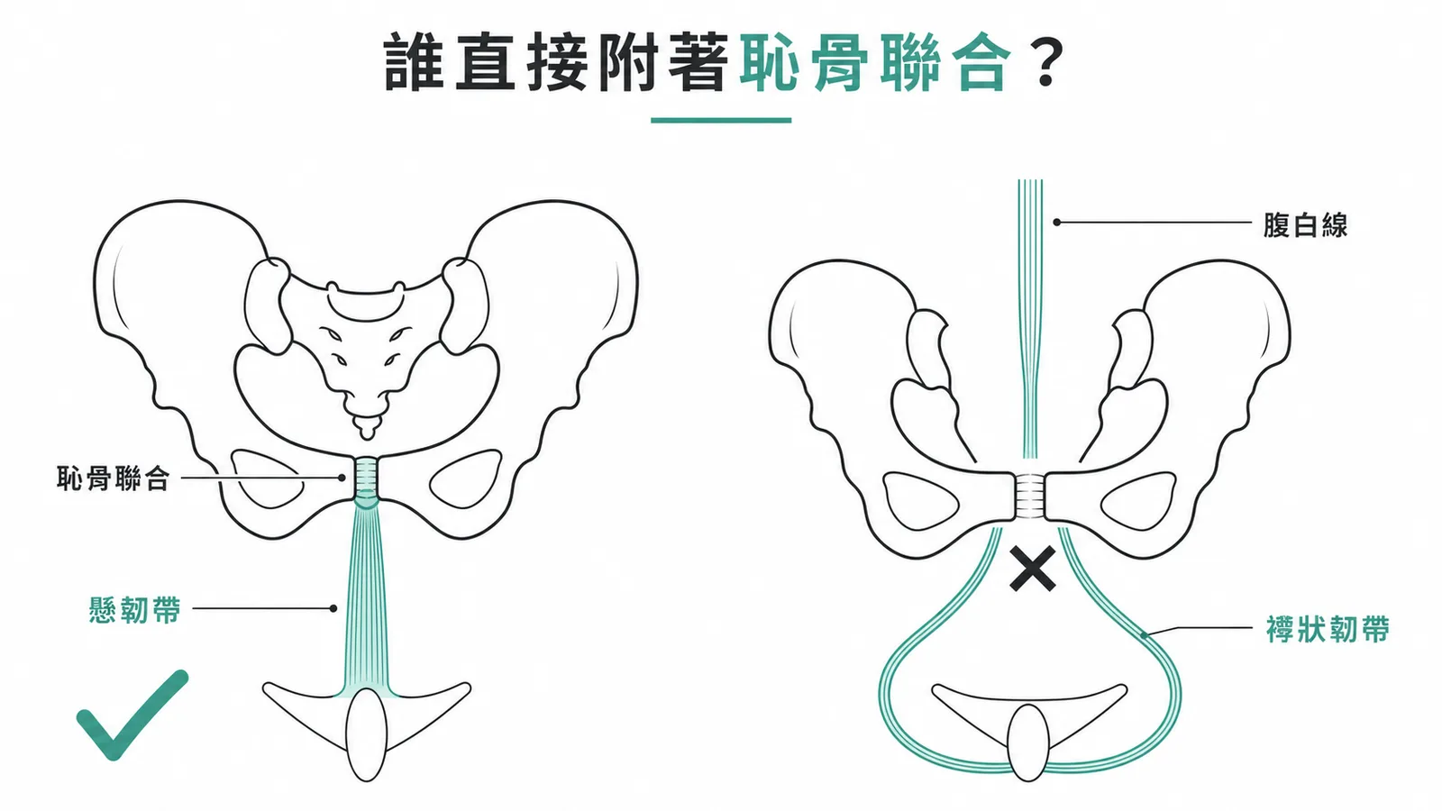 陰莖懸韌帶附著恥骨聯合與襻狀韌帶附著差異對照