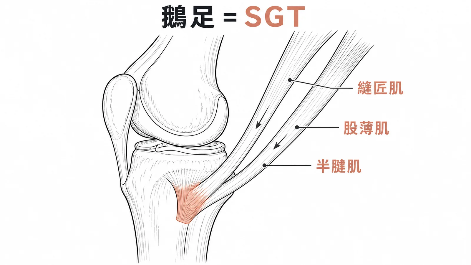 鵝足由縫匠肌股薄肌半腱肌三條肌腱在脛骨內側匯合