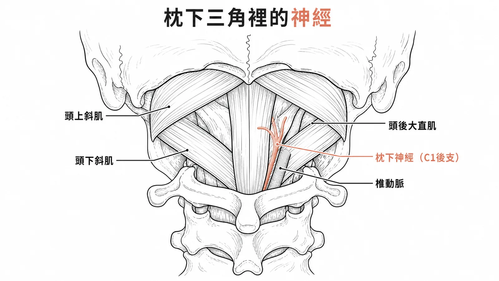 枕下三角內枕下神經與椎動脈的位置示意