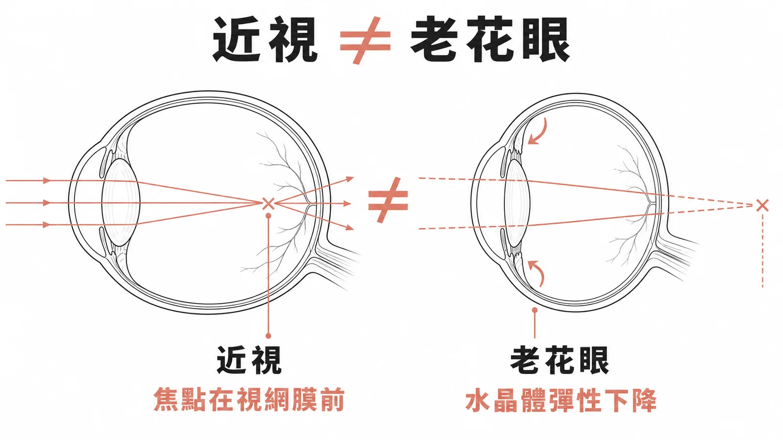 近視與老花眼的差異:近視焦點在視網膜前,老花眼是水晶體彈性下降導致調節力不足