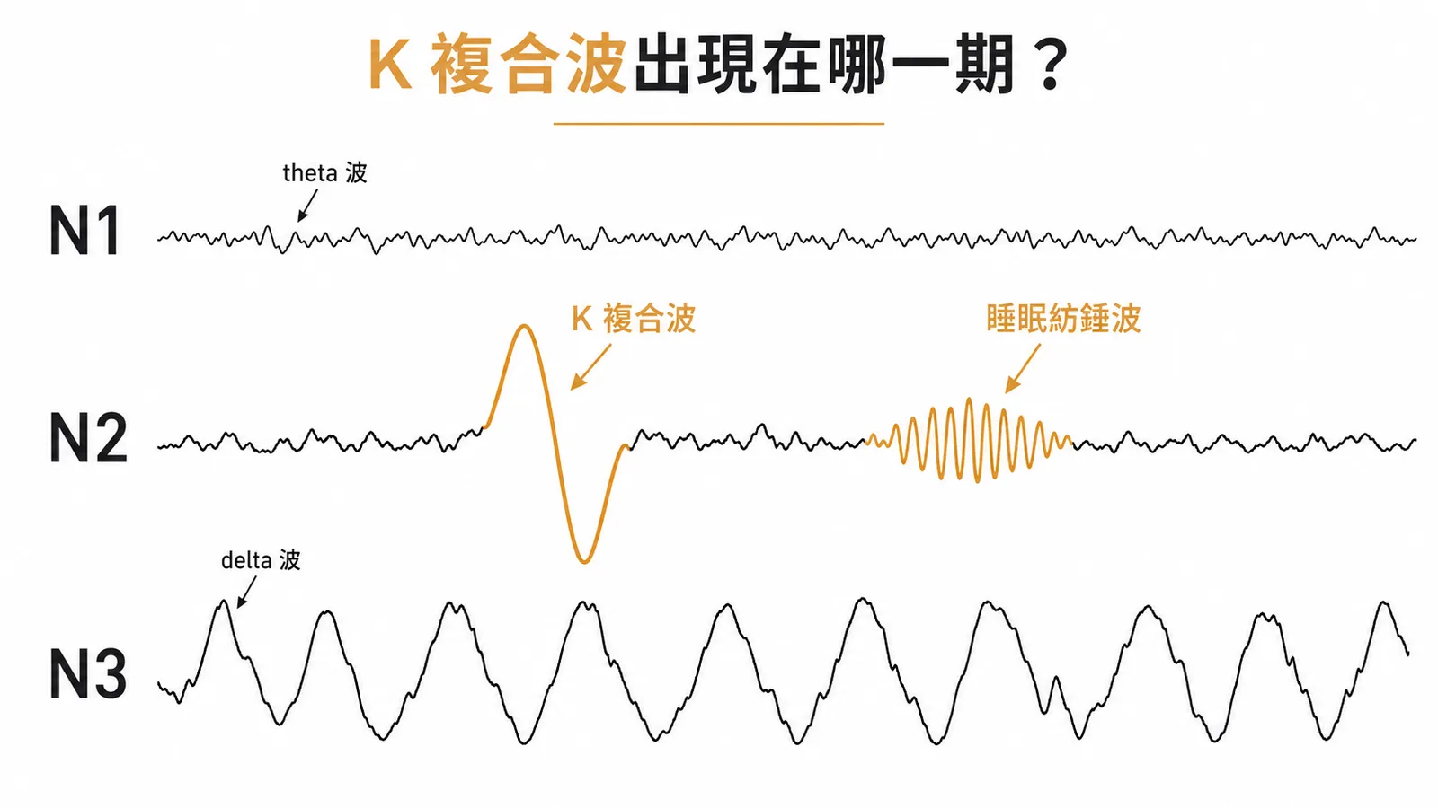 K複合波與睡眠紡錘波是N2淺睡期的EEG標誌