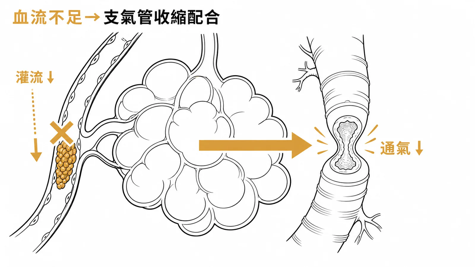 肺小動脈阻塞導致灌流下降,反射性支氣管收縮減少通氣以匹配V/Q