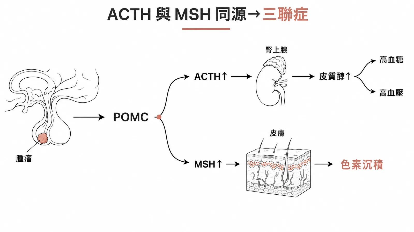 POMC分叉為ACTH和MSH,ACTH過多導致高血糖高血壓,MSH過多導致色素沉積
