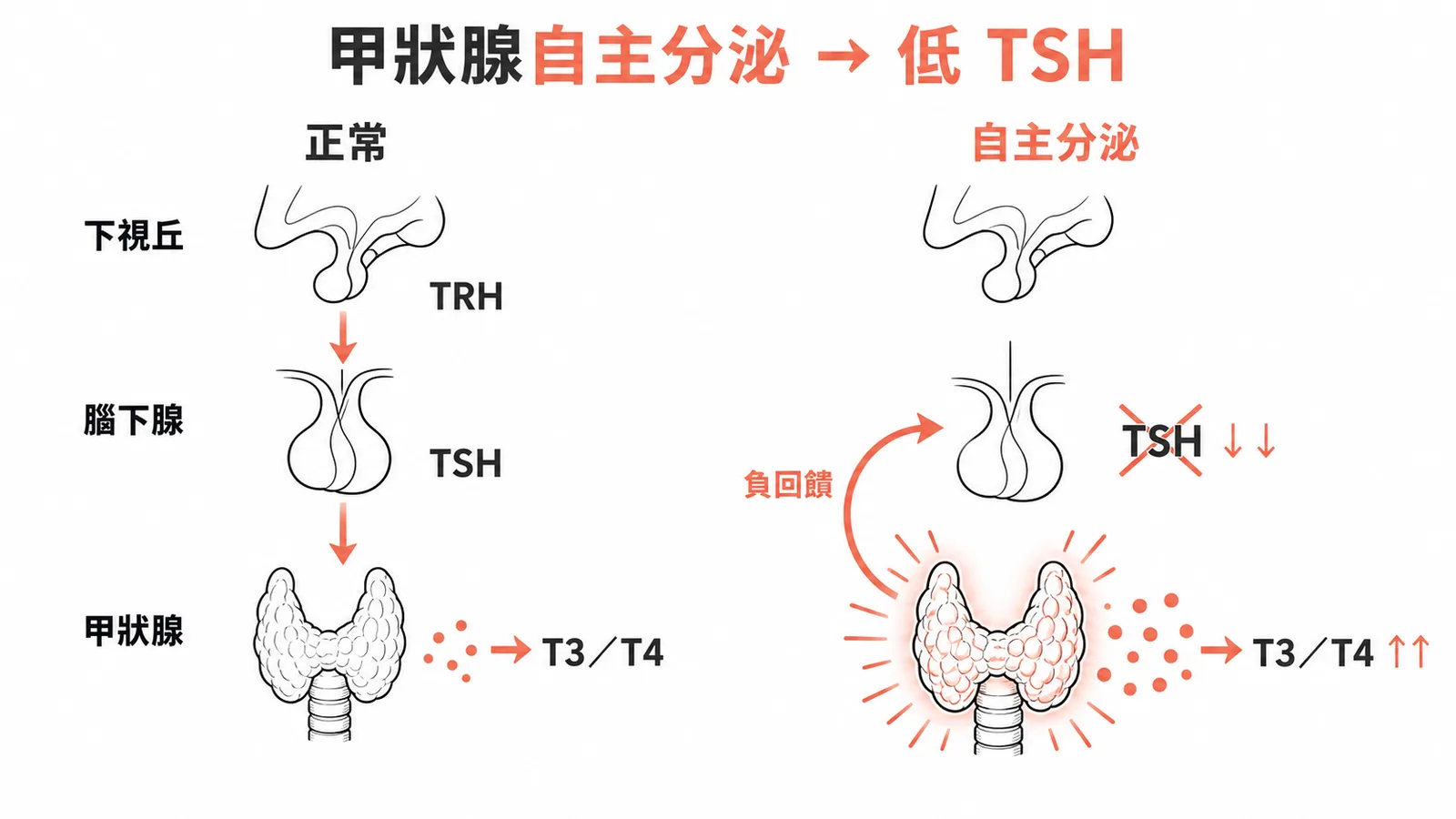 甲狀腺自主分泌時 HPT 軸負回饋使 TSH 降低的機轉圖解