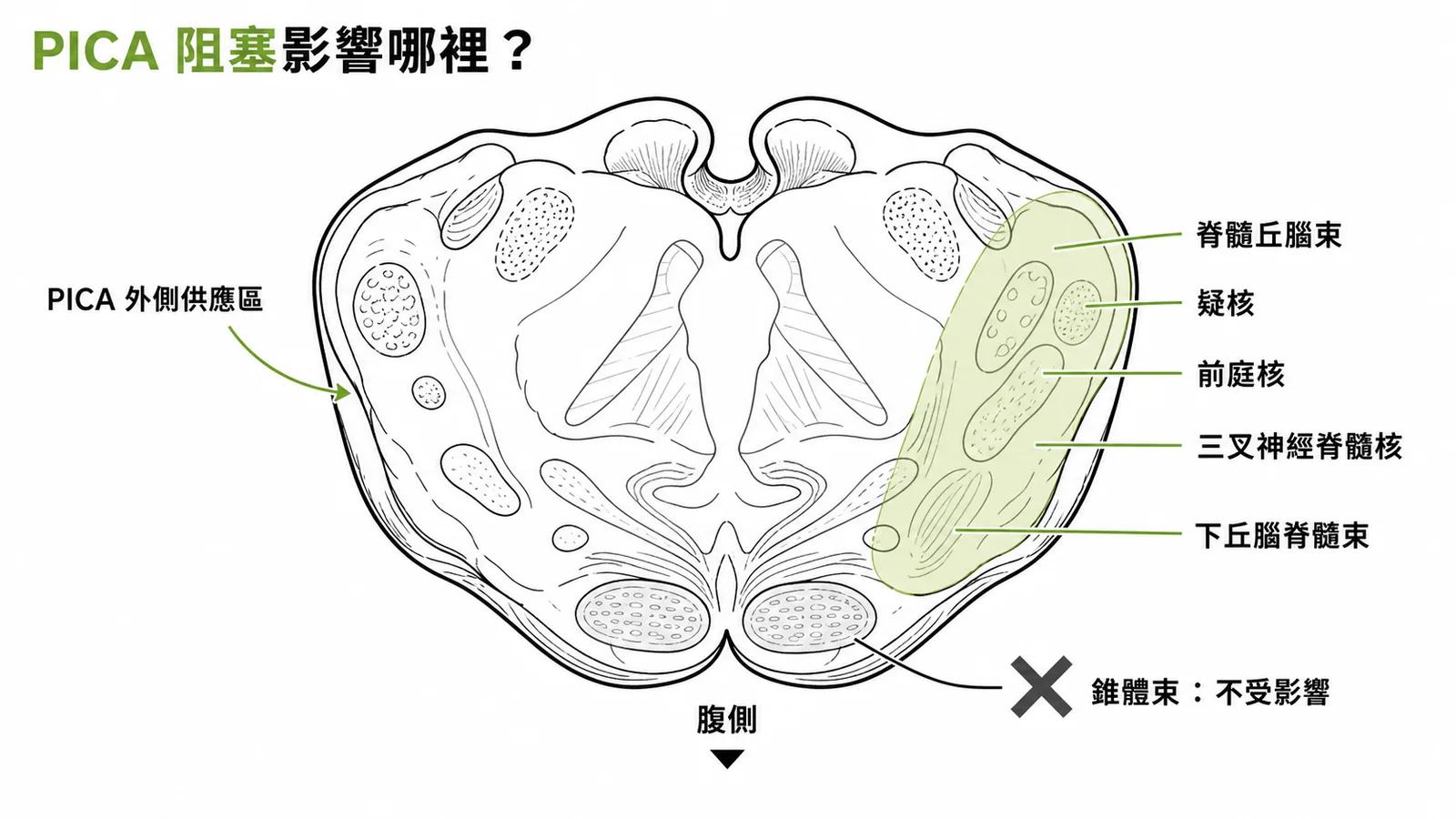 延腦橫斷面顯示PICA供應外側區域而錐體束位於腹側不受影響
