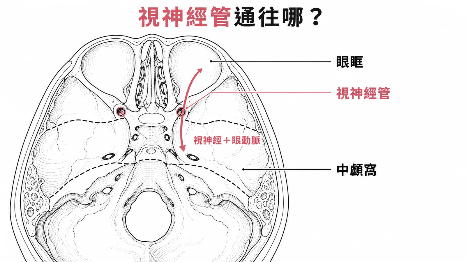 視神經管位於蝶骨小翼連接眼眶與中顱窩