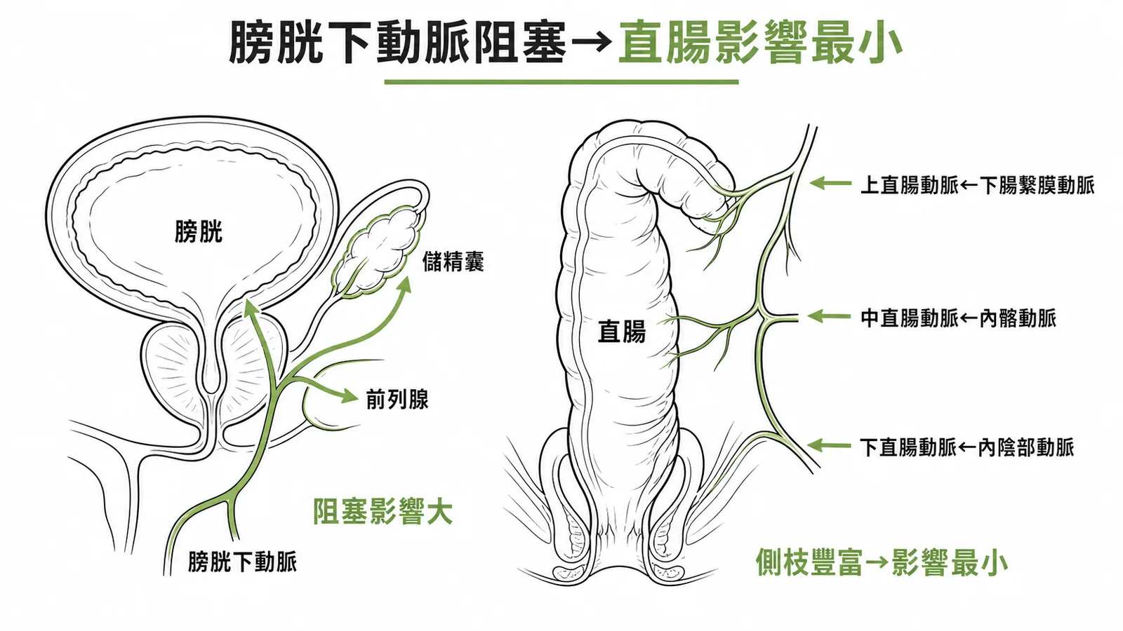 膀胱下動脈供應膀胱、儲精囊、前列腺，直腸有三條動脈側枝豐富影響最小