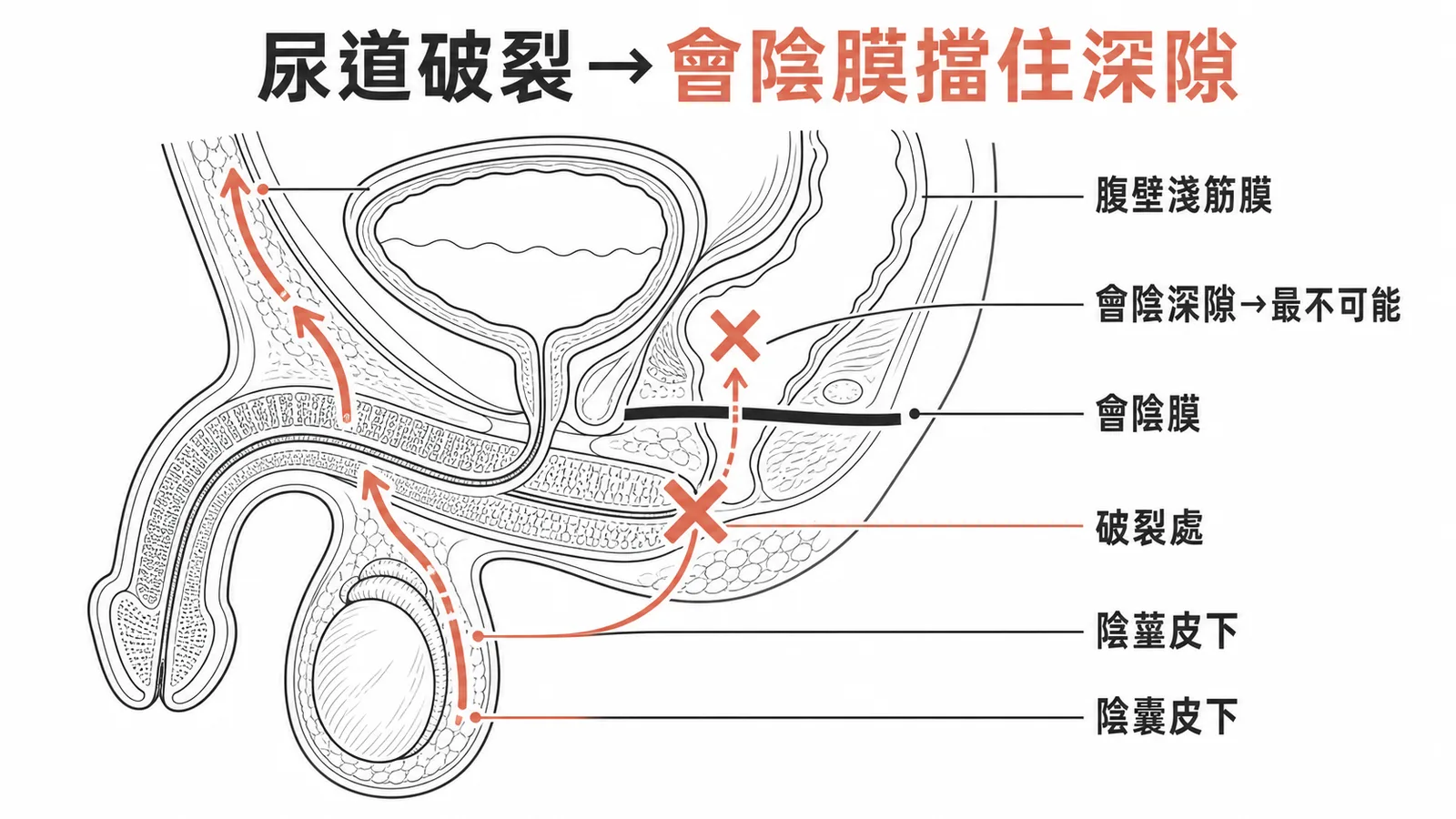 海綿體尿道破裂時會陰膜阻擋尿液進入深隙，尿液沿淺筋膜蔓延