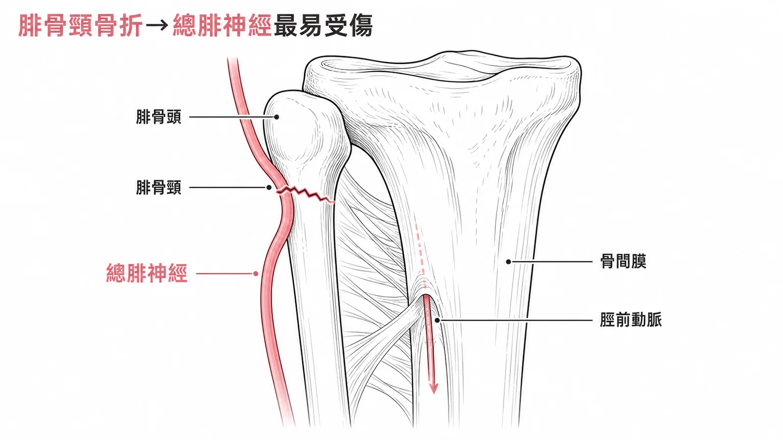 總腓神經繞過腓骨頸部，脛前動脈穿過骨間膜，腓骨頸骨折最易傷及此處