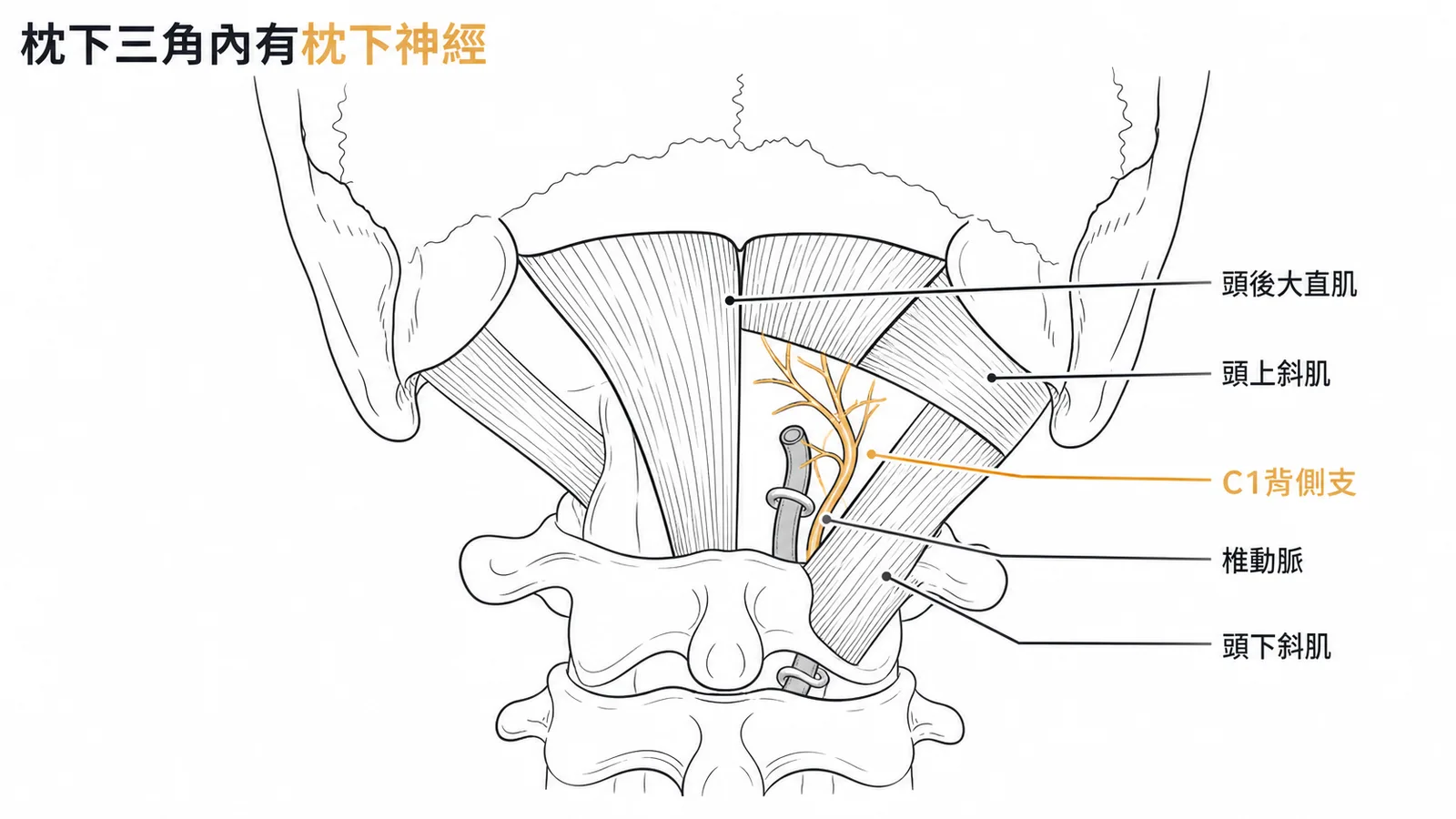 枕下三角由三塊深層肌肉圍成，內有枕下神經（C1背側支）和椎動脈