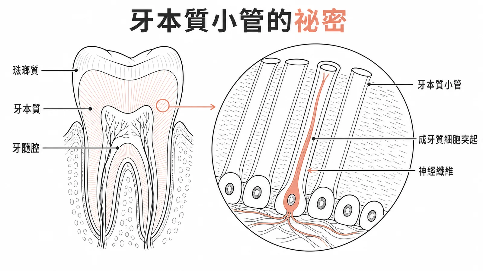 牙本質小管內含成牙質細胞突起與神經纖維的放大示意圖