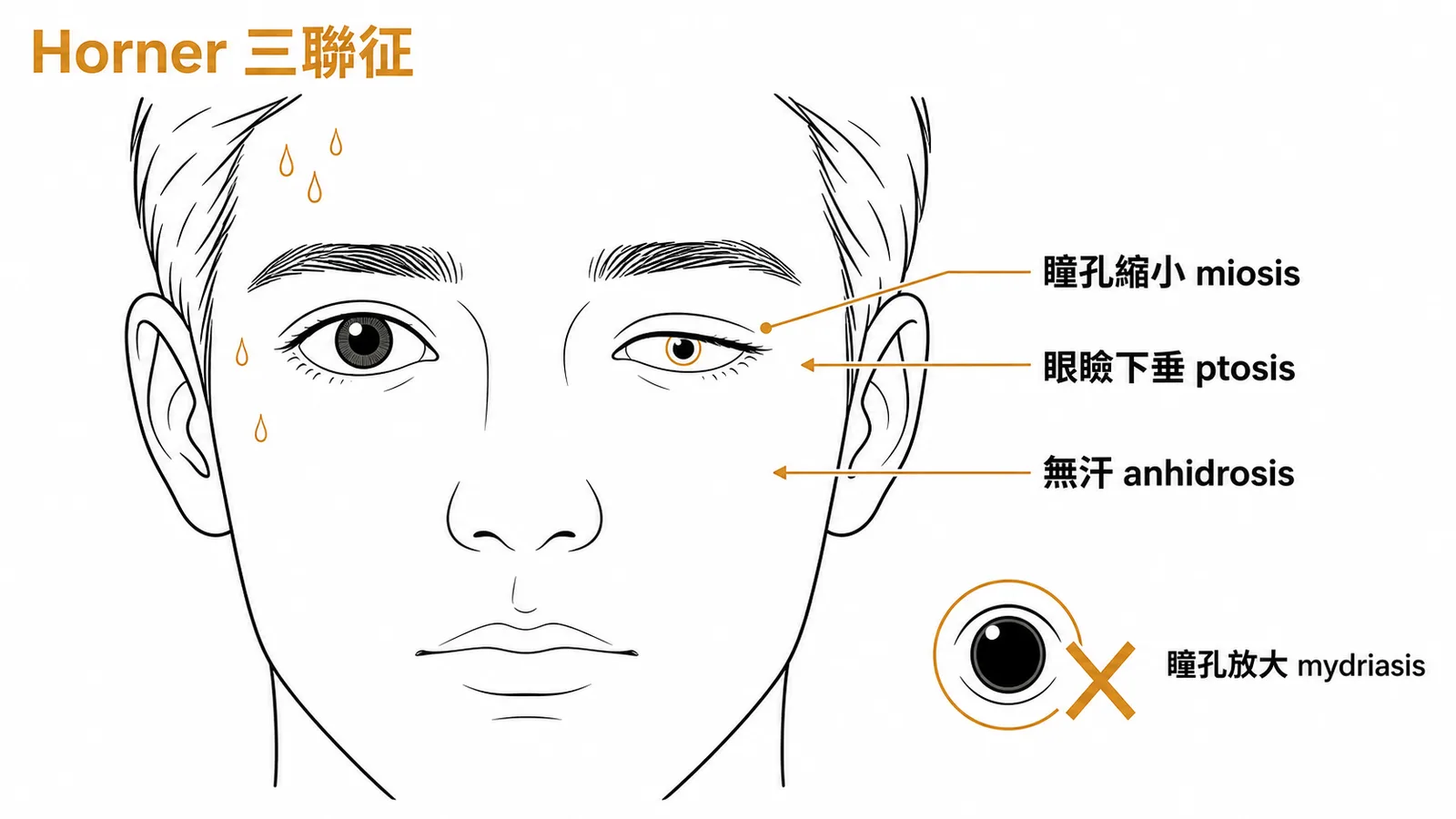 Horner症候群三聯征:瞳孔縮小、眼瞼下垂、無汗的臉部對照圖