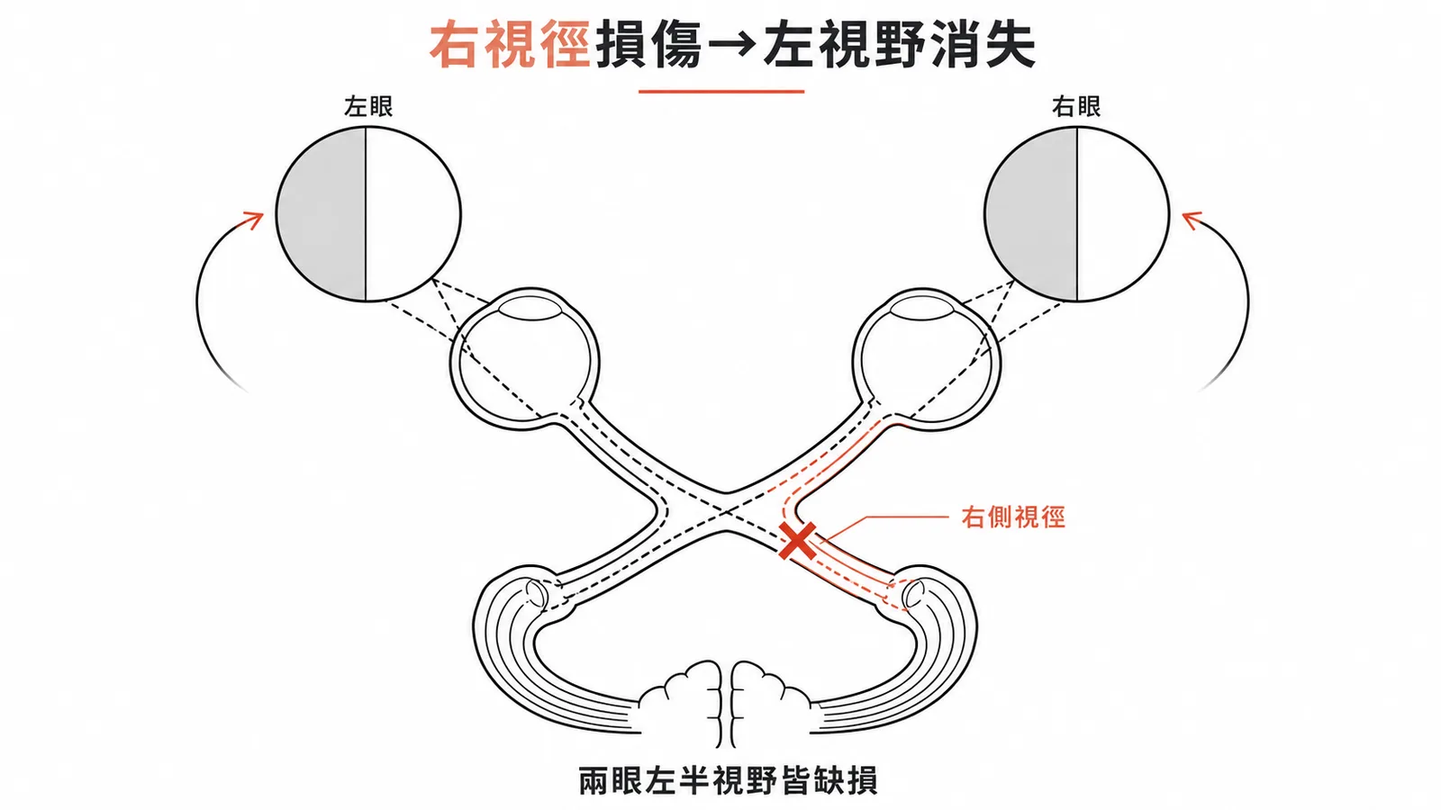 右側視徑損傷導致兩眼左半視野消失（左同側偏盲）的視覺路徑示意圖
