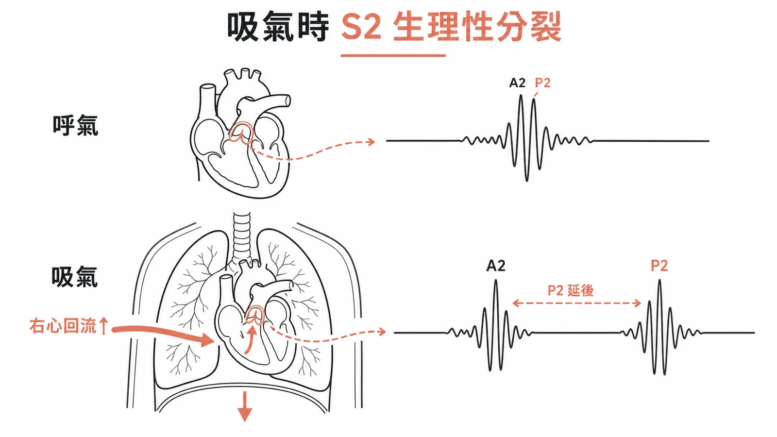 吸氣時右心回流增加使P2延後，造成第二心音S2生理性分裂