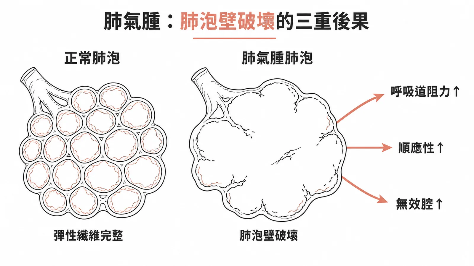 肺氣腫肺泡壁破壞導致呼吸道阻力、順應性、無效腔三重變化