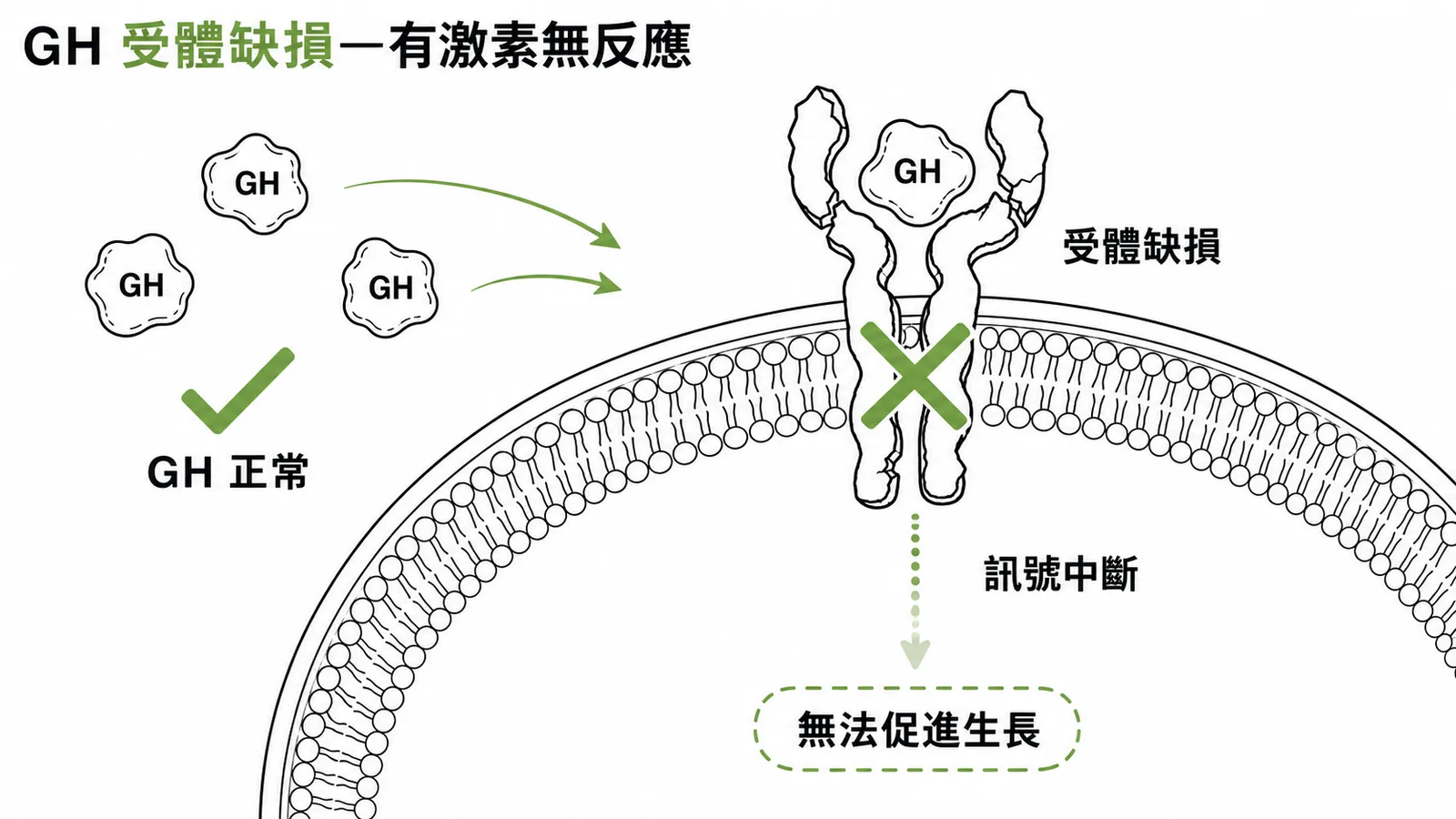 生長激素受體缺損導致有激素卻無法促進生長的示意圖
