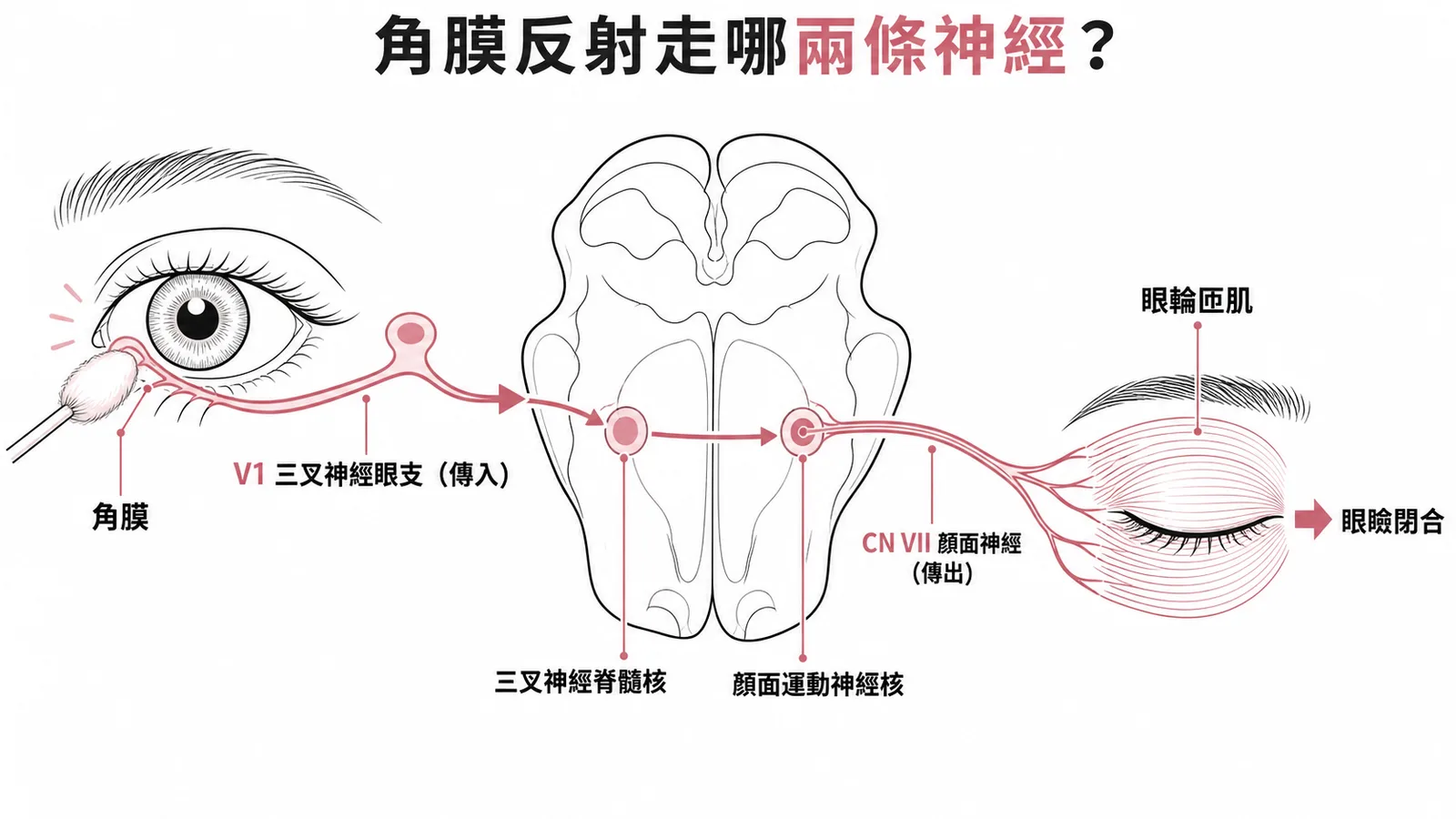 角膜反射弧:V1三叉神經眼支傳入至脊髓核,CN VII顏面神經傳出至眼輪匝肌