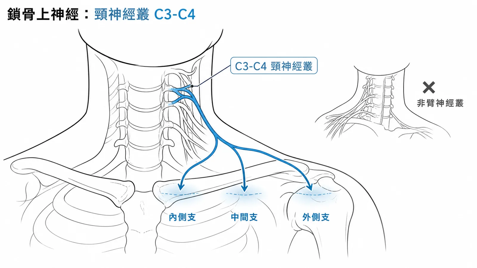 鎖骨上神經源自頸神經叢C3-C4，分三支支配肩頸皮膚