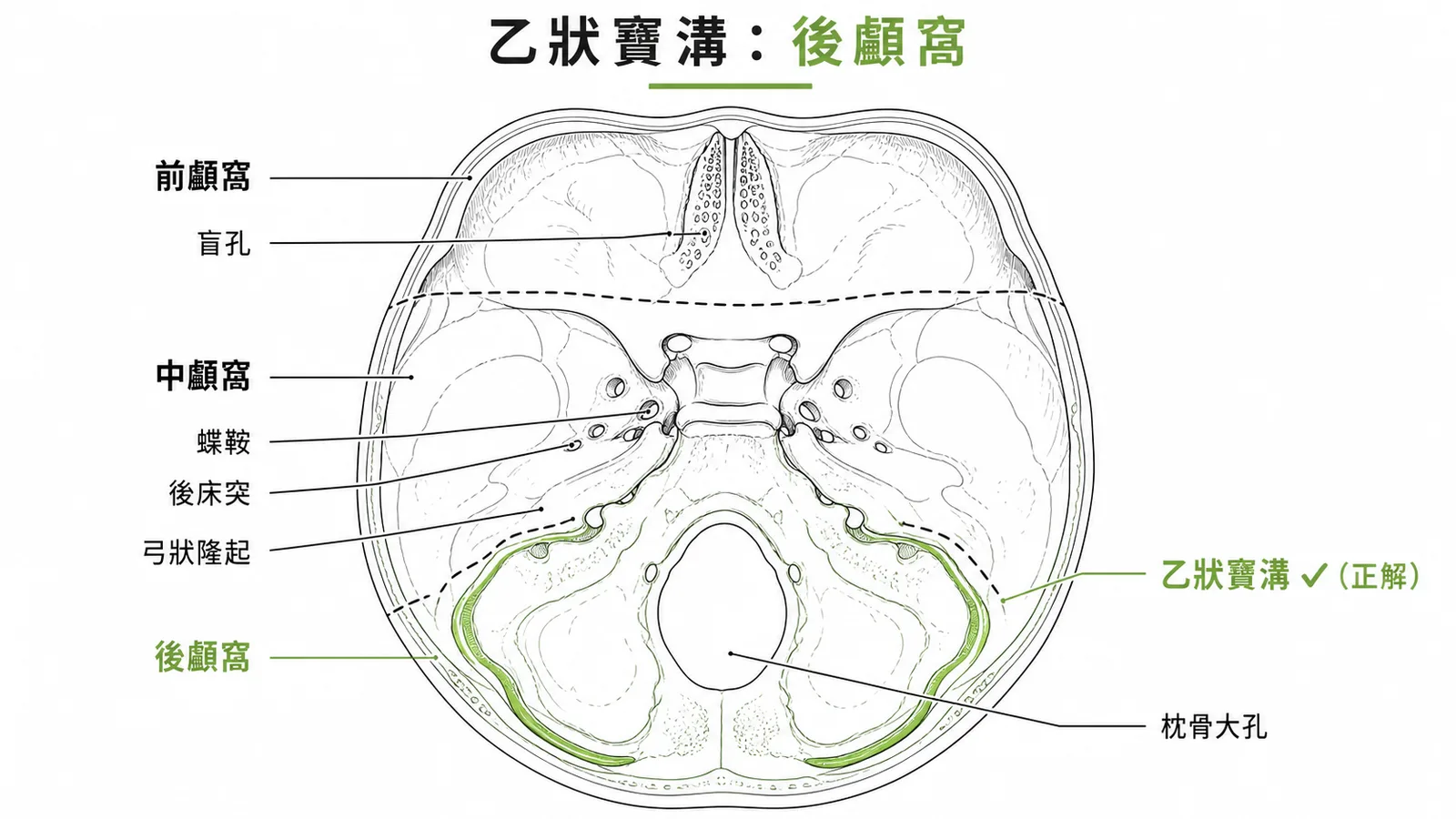 顱底俯視圖:三窩分區,乙狀竇溝位於後顱窩