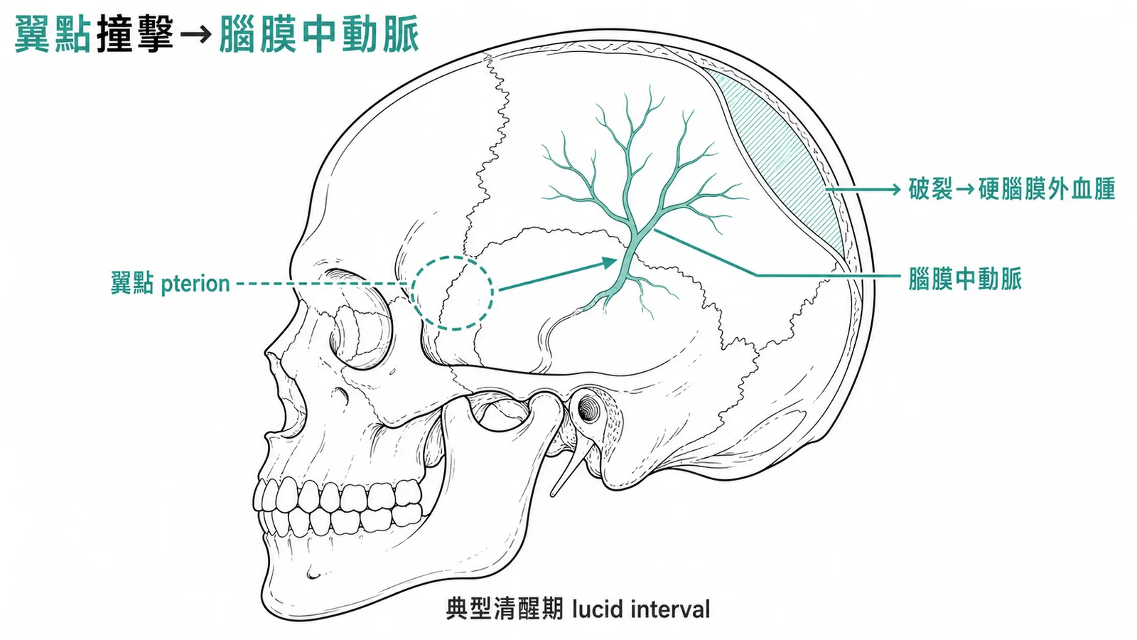 翼點撞擊導致腦膜中動脈破裂形成硬腦膜外血腫