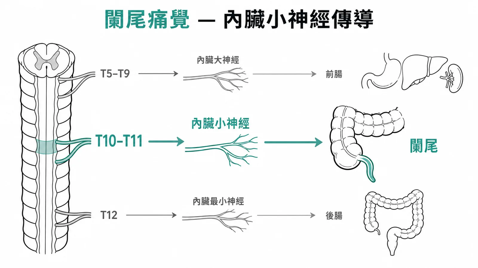 闌尾痛覺經內臟小神經（T10-T11）傳導，對應中腸衍生物