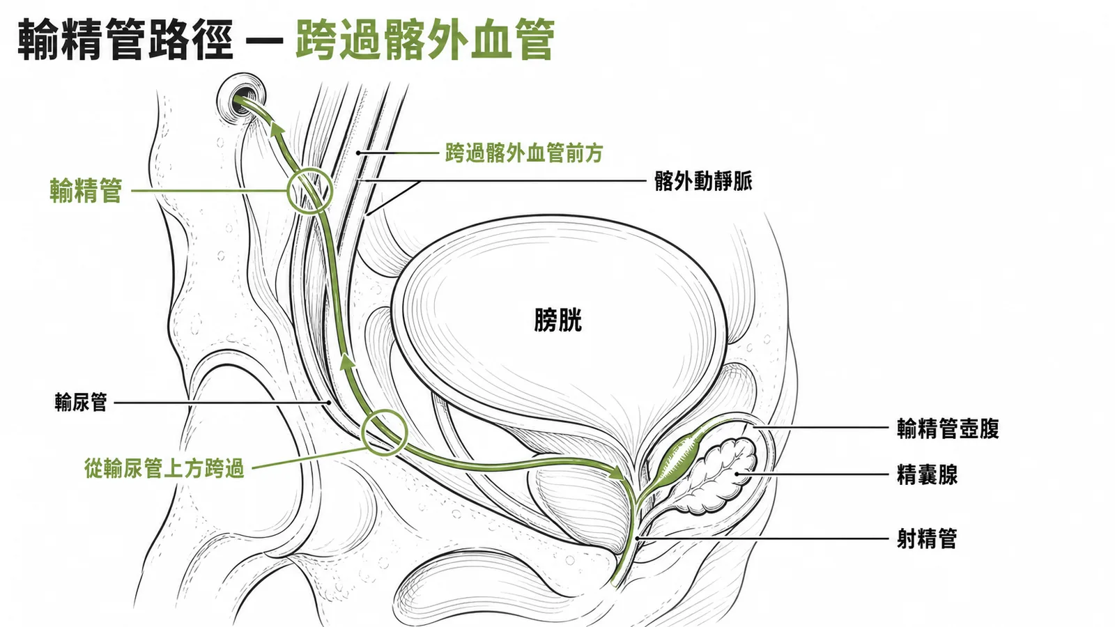 輸精管從深環進入骨盆後跨過髂外血管前方,再從輸尿管上方跨過到膀胱後方