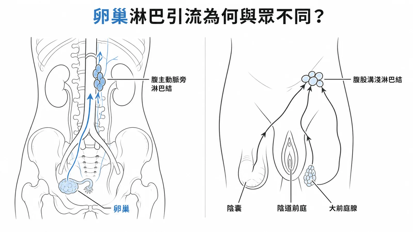 卵巢淋巴引流至腹主動脈旁淋巴結 vs 外生殖器引流至腹股溝淺淋巴結的對照路線圖