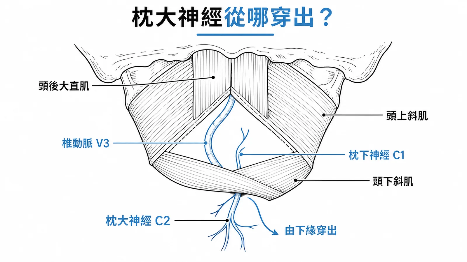 枕下三角邊界與枕大神經從頭下斜肌下方穿出的路線圖