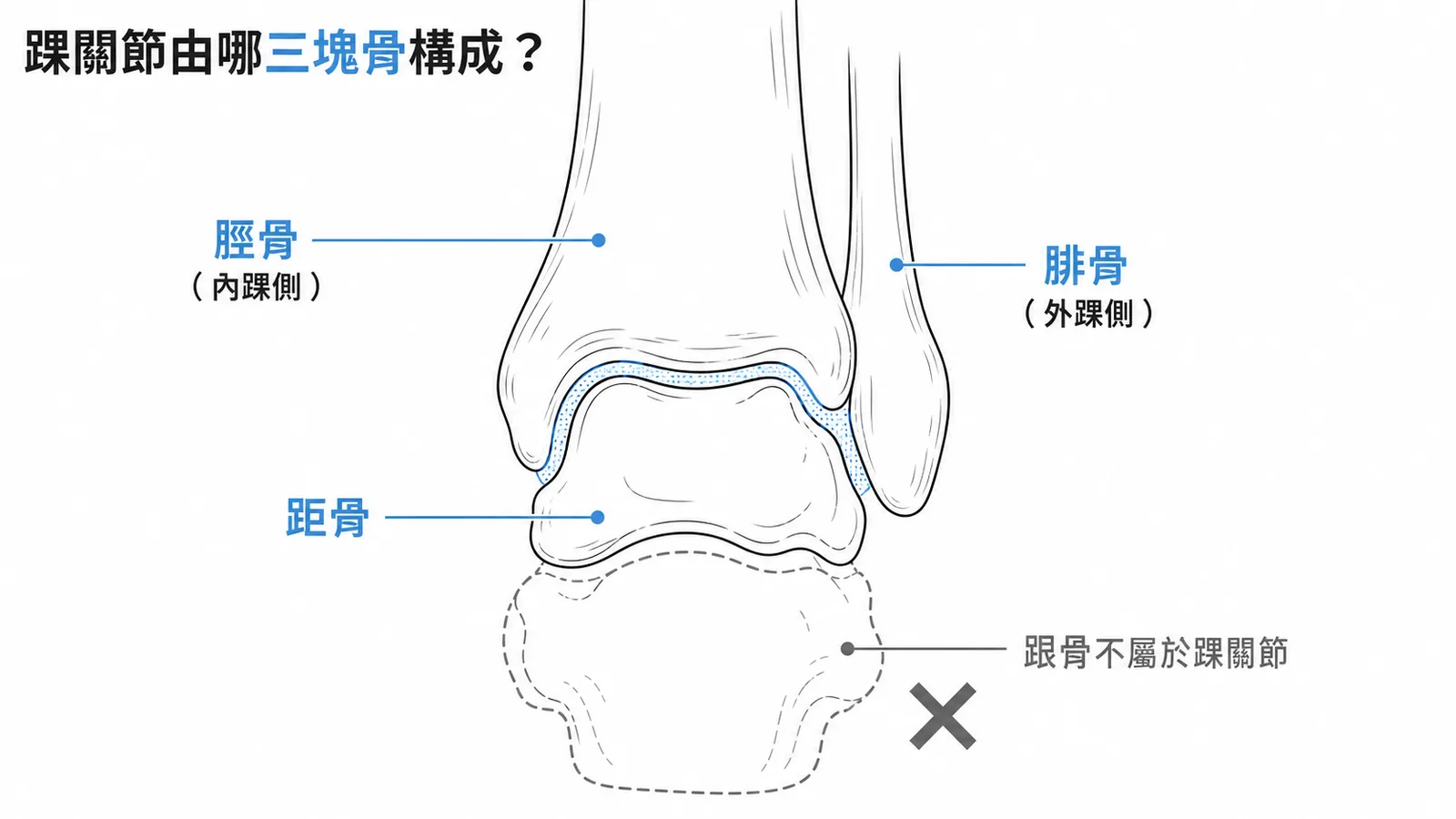踝關節前視圖:脛骨腓骨包夾距骨形成踝穴,跟骨不屬於踝關節