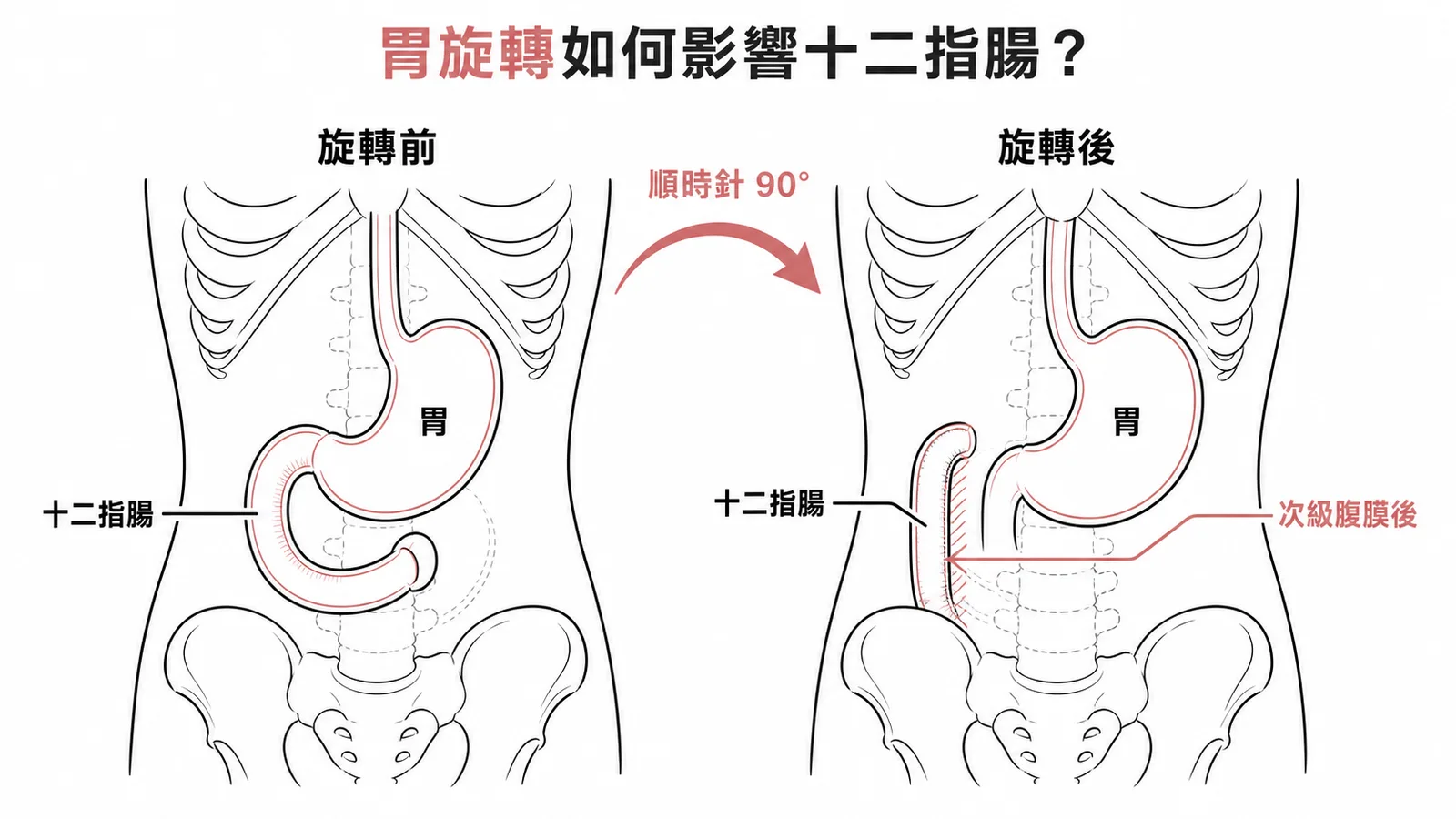 胃旋轉前後對比:十二指腸被帶到右側成為次級腹膜後器官